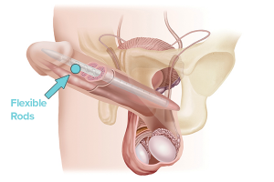 Flexible implant with flexible rods